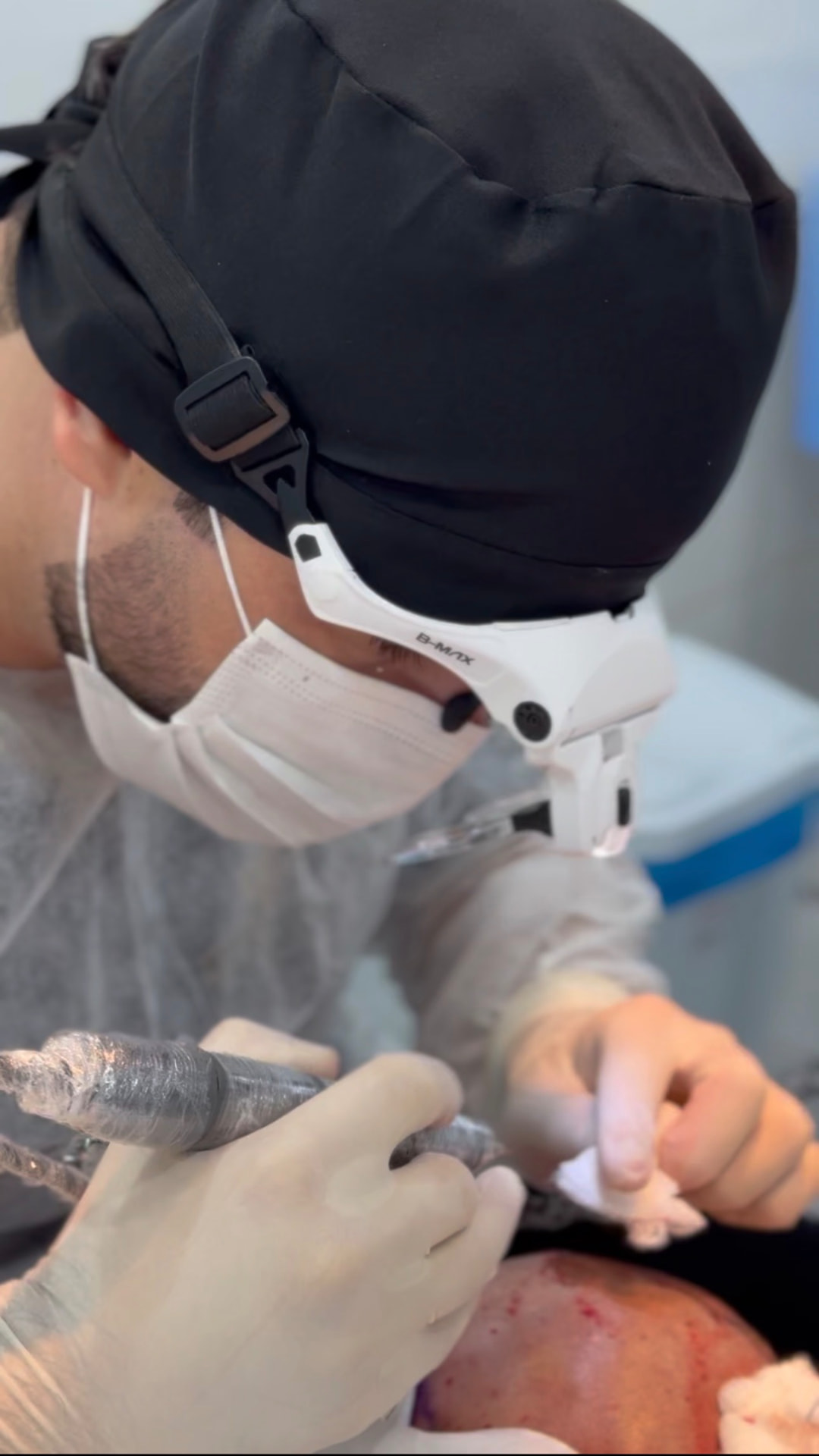 Dr. Valton Marques realizando transplante capilar — registro 1
