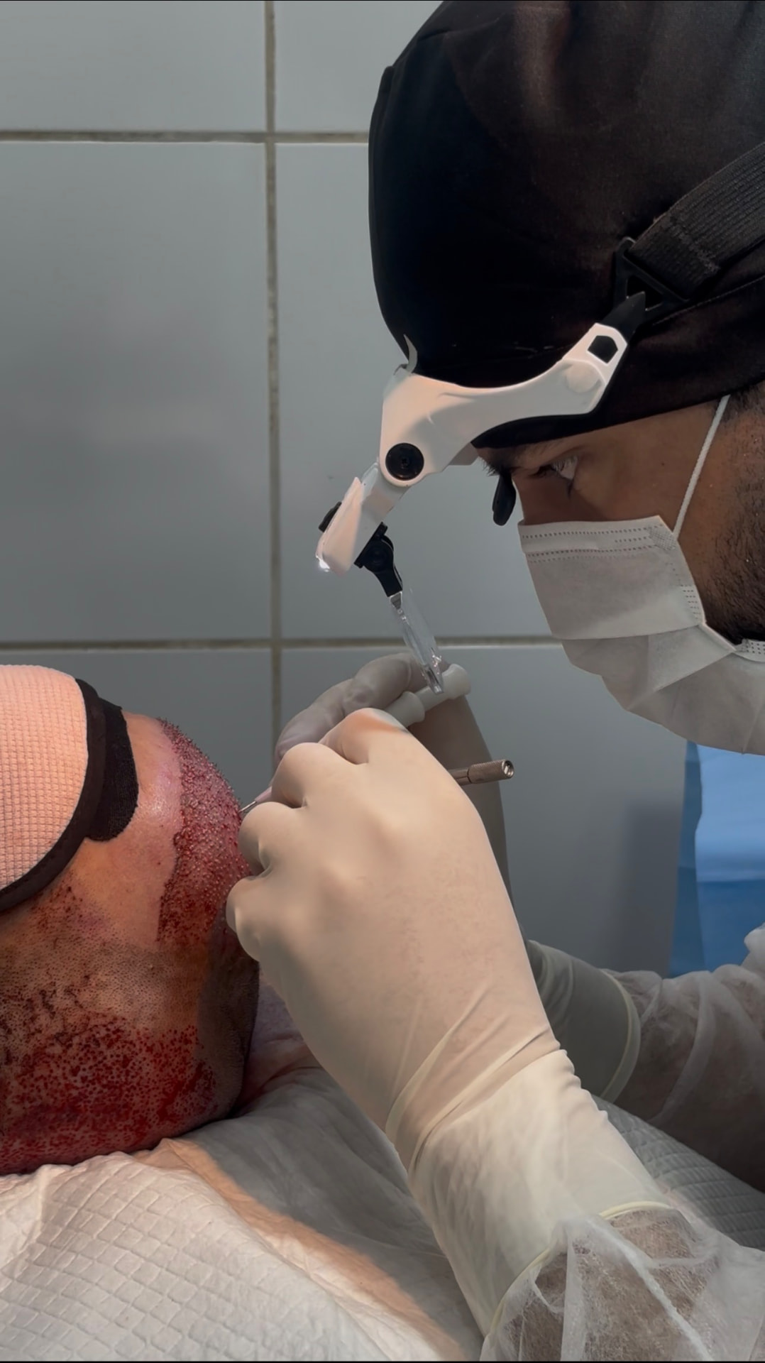 Dr. Valton Marques realizando transplante capilar — registro 2